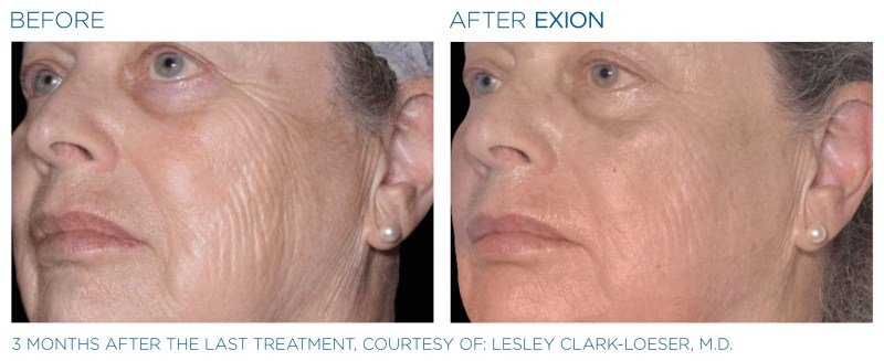 Exion-Before-and-After-Image-010