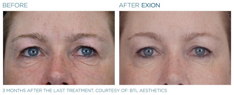 Exion-Before-and-After-Image-08